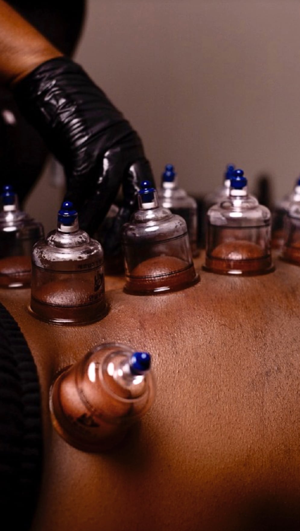 A close-up of cups drawing up the skin on a patient's back
