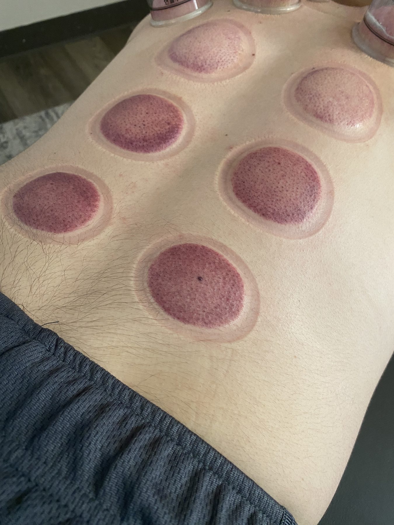 Circular cupping marks on a patient's lower back after a session