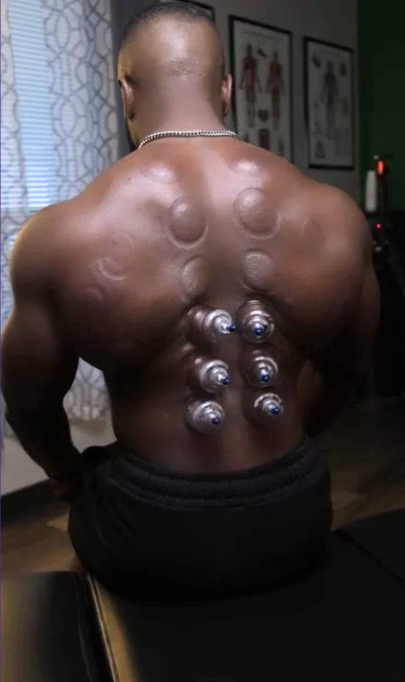A row of cups placed down a patient's spine