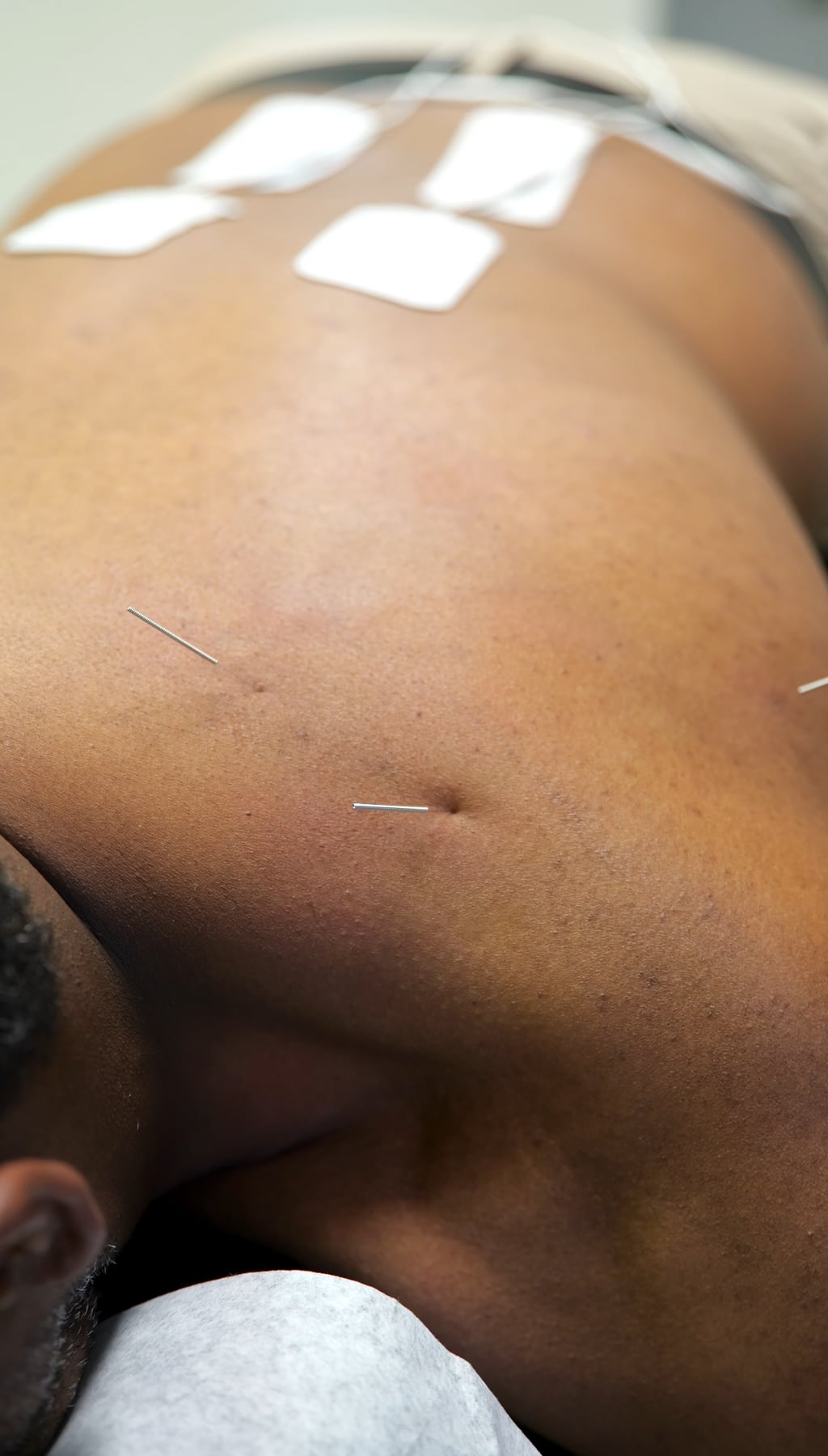 Fine needles placed in the muscle of a patient's back during dry needling