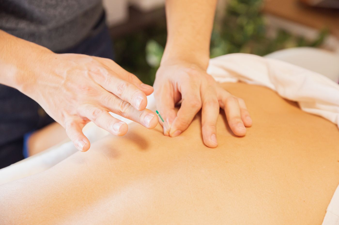 Fine needles placed along a patient's back