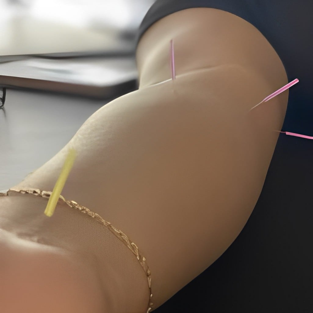 Fine needles placed along a patient's thigh during a dry needling session